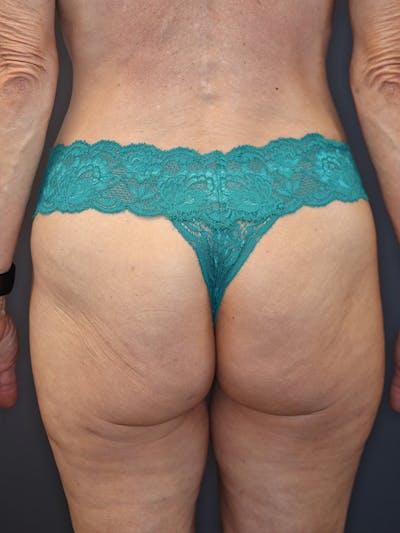 Renuvion Before & After Gallery - Patient 250271 - Image 2