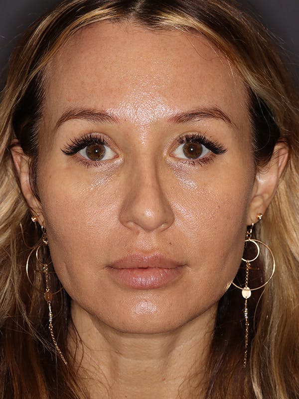 Brow Lift in San Francisco Before and After