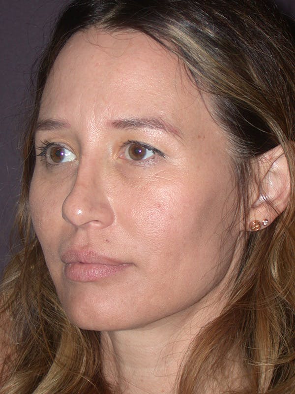Brow Lift Gallery Before & After Gallery - Patient 211055 - Image 3
