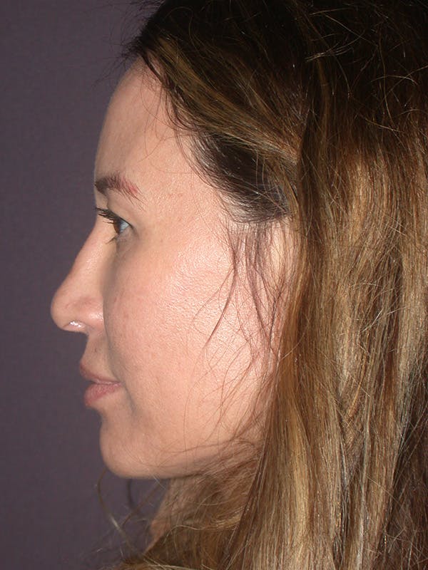 Brow Lift Gallery Before & After Gallery - Patient 211055 - Image 5