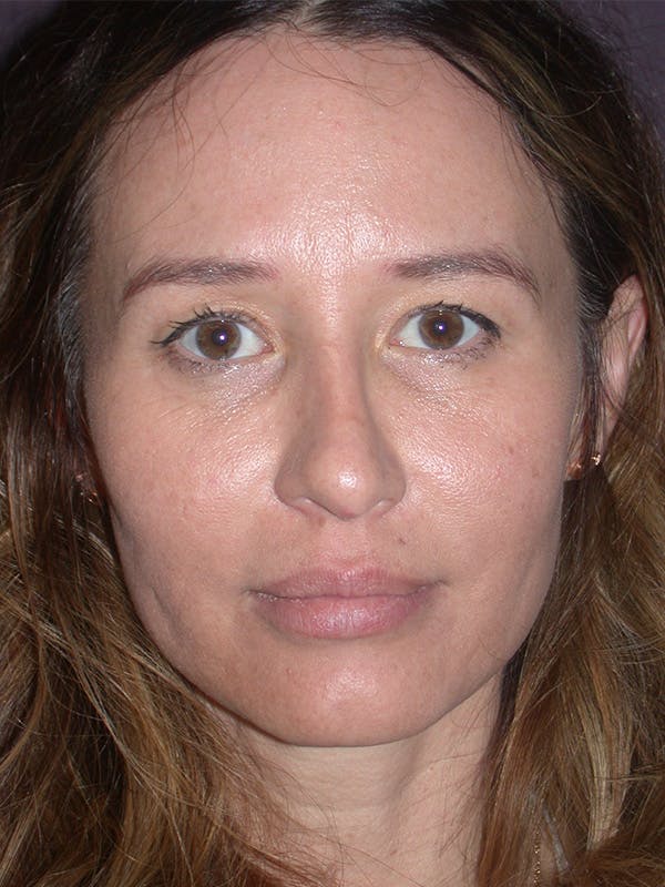 Brow Lift in San Francisco Before and After