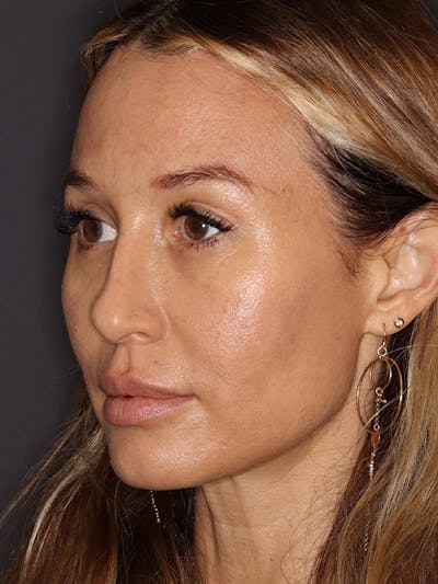 Brow Lift Gallery Before & After Gallery - Patient 211055 - Image 4