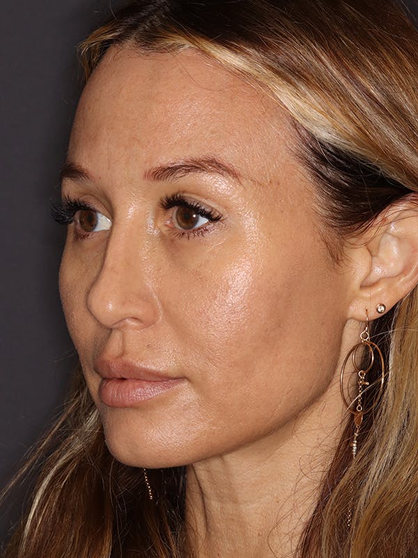 Brow Lift Gallery Before & After Gallery - Patient 211055 - Image 4
