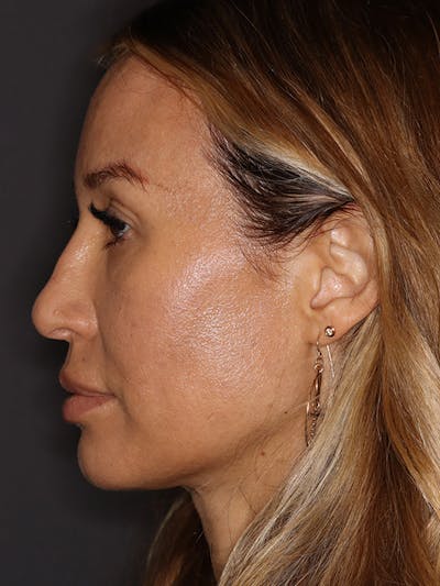 Brow Lift Gallery Before & After Gallery - Patient 211055 - Image 6