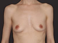 Breast Augmentation Gallery Before & After Gallery - Patient 423781 - Image 1
