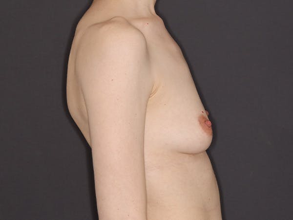 Breast Augmentation Gallery Before & After Gallery - Patient 423781 - Image 5