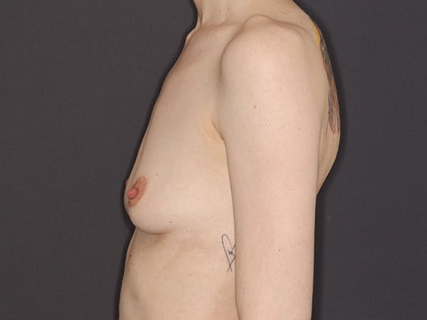 Breast Augmentation Gallery Before & After Gallery - Patient 423781 - Image 9