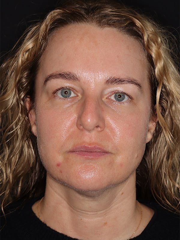 Eyelid Lift Gallery Before & After Gallery - Patient 942727 - Image 1