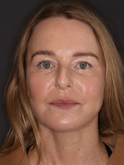 Eyelid Lift Gallery Before & After Gallery - Patient 942727 - Image 2