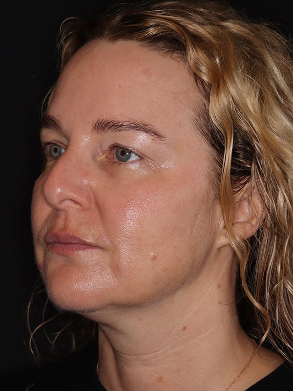 Eyelid Lift Gallery Before & After Gallery - Patient 942727 - Image 3