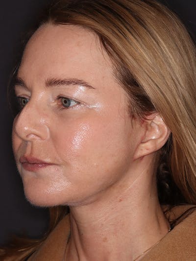 Eyelid Lift Gallery Before & After Gallery - Patient 942727 - Image 4