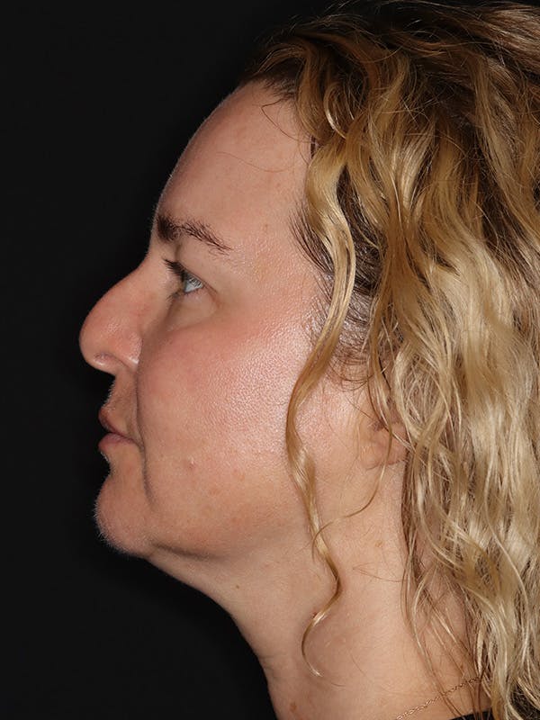 Eyelid Lift Gallery Before & After Gallery - Patient 942727 - Image 5