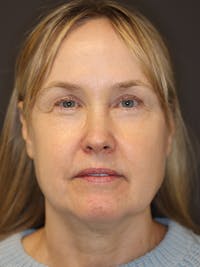 Facelift Gallery Before & After Gallery - Patient 181935 - Image 1