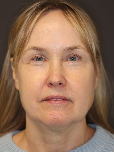 Facelift Gallery Before & After Gallery - Patient 181935 - Image 1