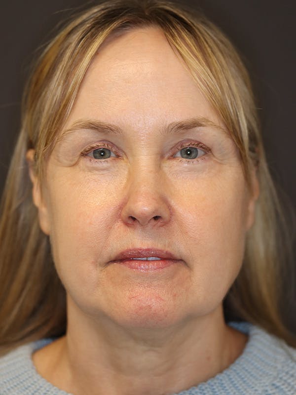 Facelift Gallery Before & After Gallery - Patient 181935 - Image 1