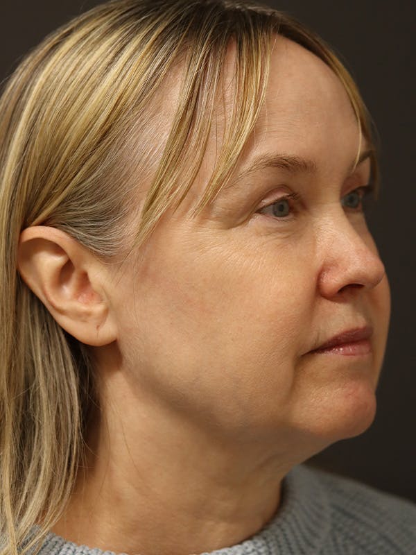 Facelift Gallery Before & After Gallery - Patient 181935 - Image 3