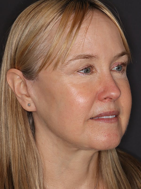 Facelift Gallery Before & After Gallery - Patient 181935 - Image 4