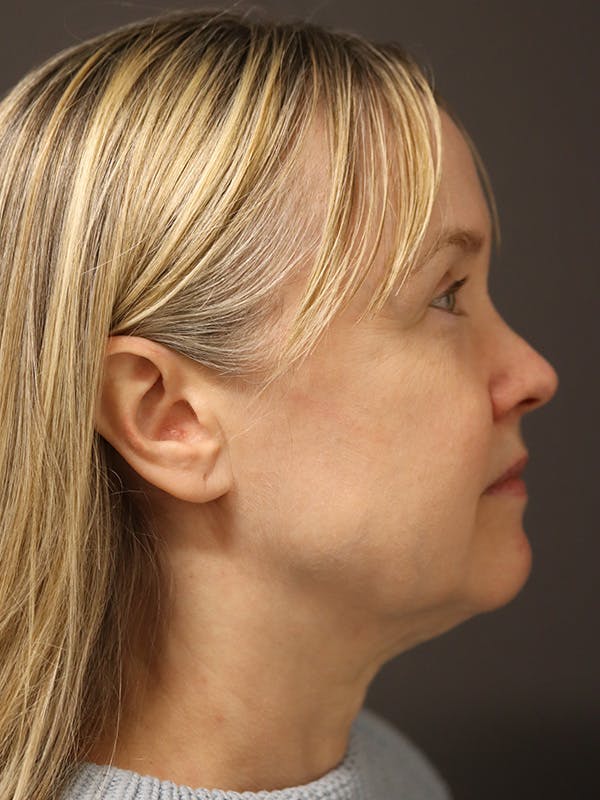 Facelift Gallery Before & After Gallery - Patient 181935 - Image 5