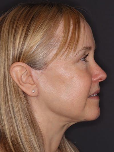 Facelift Gallery Before & After Gallery - Patient 181935 - Image 6