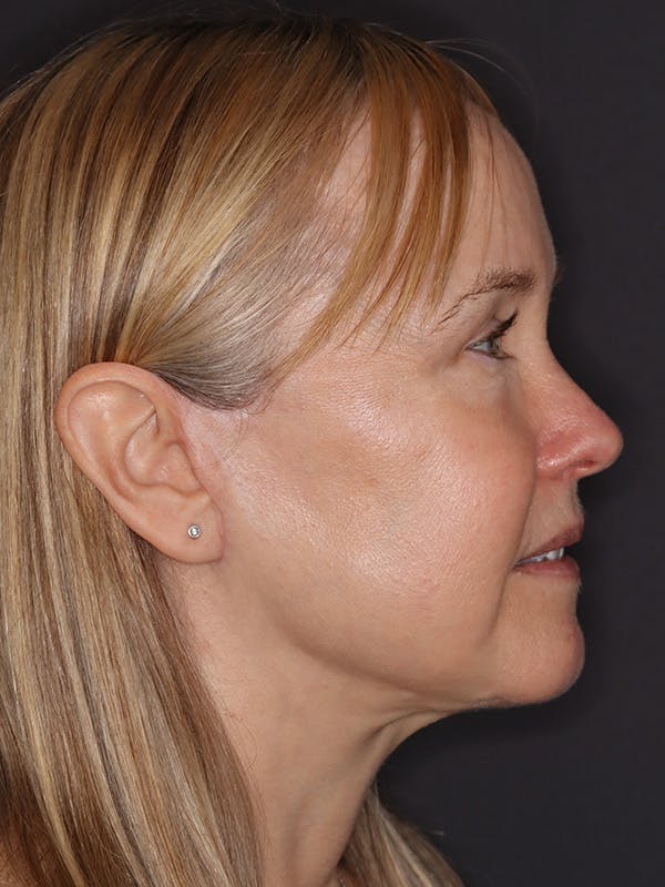Facelift Gallery Before & After Gallery - Patient 181935 - Image 6