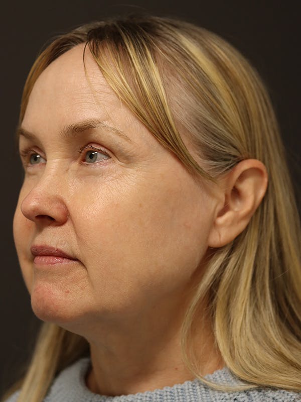 Facelift Gallery Before & After Gallery - Patient 181935 - Image 7