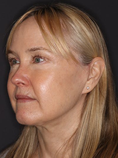 Facelift Gallery Before & After Gallery - Patient 181935 - Image 8