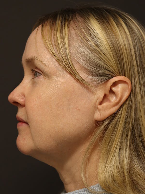 Facelift Gallery Before & After Gallery - Patient 181935 - Image 9