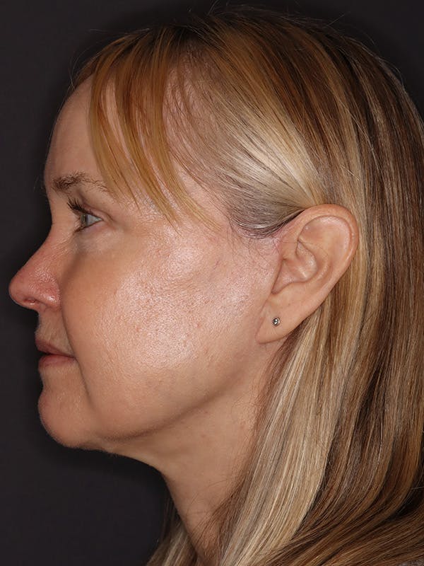 Facelift Gallery Before & After Gallery - Patient 181935 - Image 10