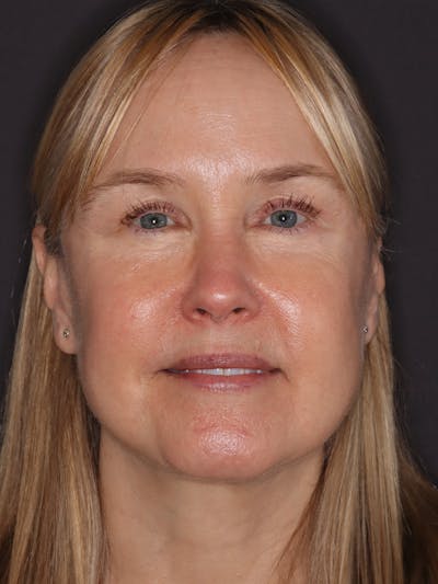 Facelift Gallery Before & After Gallery - Patient 181935 - Image 2