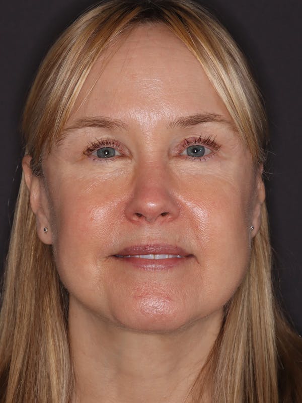 Facelift Gallery Before & After Gallery - Patient 181935 - Image 2