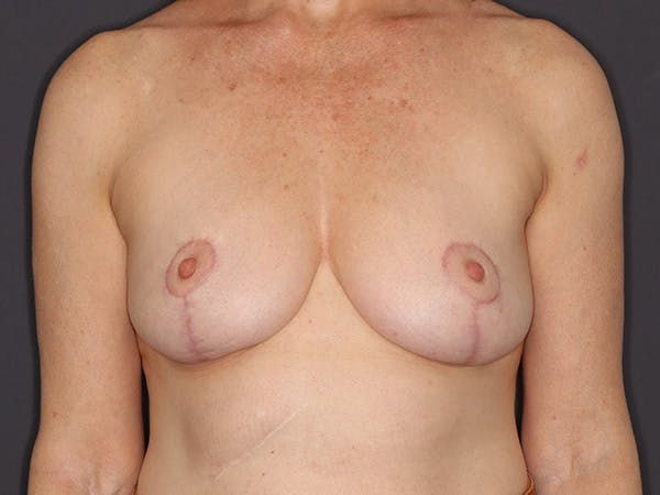 Breast Lift Gallery Before & After Gallery - Patient 179282 - Image 2