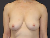Breast Lift Gallery Before & After Gallery - Patient 179282 - Image 1