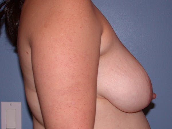 Breast Lift Gallery Before & After Gallery - Patient 265836 - Image 5