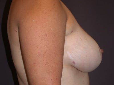 Breast Lift Gallery Before & After Gallery - Patient 265836 - Image 6