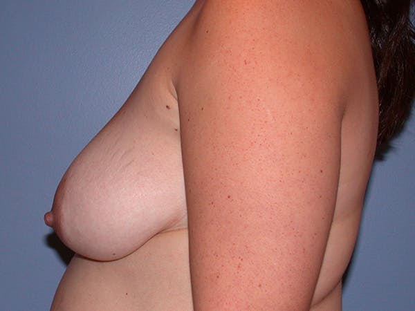 Breast Lift Gallery Before & After Gallery - Patient 265836 - Image 9