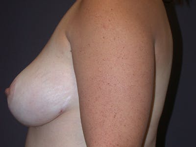 Breast Lift Gallery Before & After Gallery - Patient 265836 - Image 10