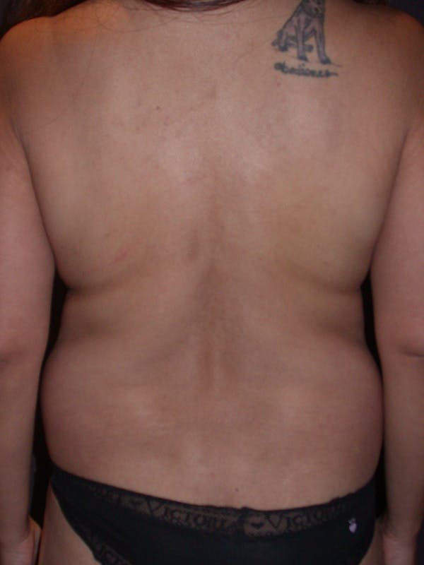 Mommy Makeover Gallery Before & After Gallery - Patient 364112 - Image 11