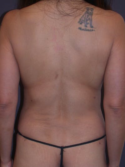 Mommy Makeover Gallery Before & After Gallery - Patient 364112 - Image 12