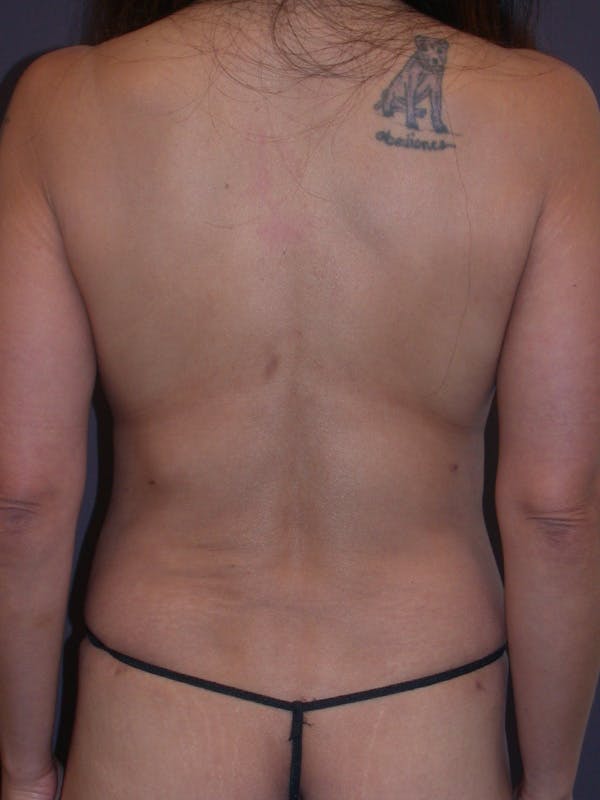 Mommy Makeover Gallery Before & After Gallery - Patient 364112 - Image 12