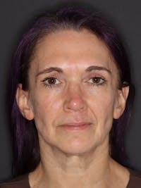 Facelift Gallery Before & After Gallery - Patient 258656 - Image 1