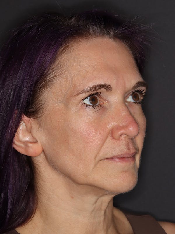 Neck Lift Gallery Before & After Gallery - Patient 543940 - Image 3