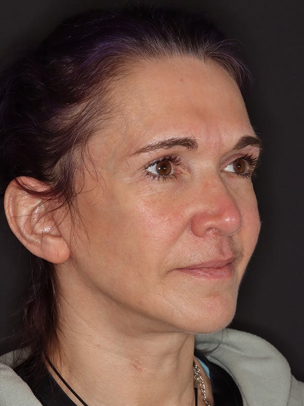 Neck Lift Gallery Before & After Gallery - Patient 543940 - Image 4