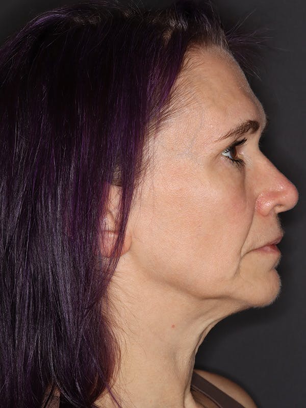 Neck Lift Gallery Before & After Gallery - Patient 543940 - Image 1