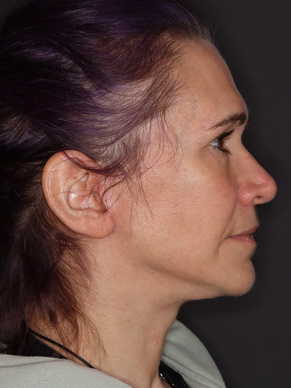 Neck Lift Gallery Before & After Gallery - Patient 543940 - Image 2