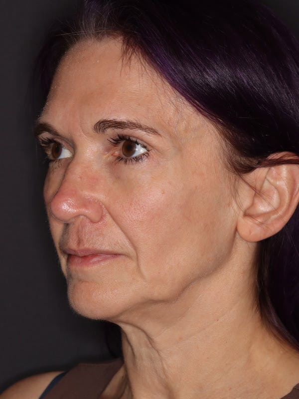 Neck Lift Gallery Before & After Gallery - Patient 543940 - Image 7