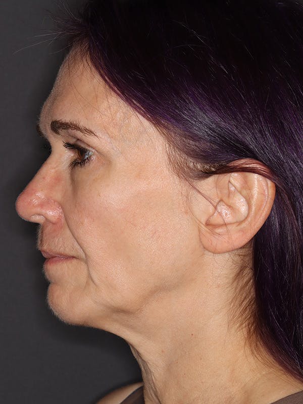 Neck Lift Gallery Before & After Gallery - Patient 543940 - Image 9