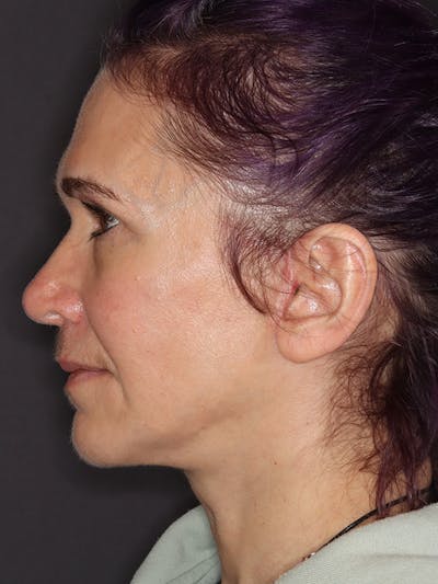 Neck Lift Gallery Before & After Gallery - Patient 543940 - Image 10