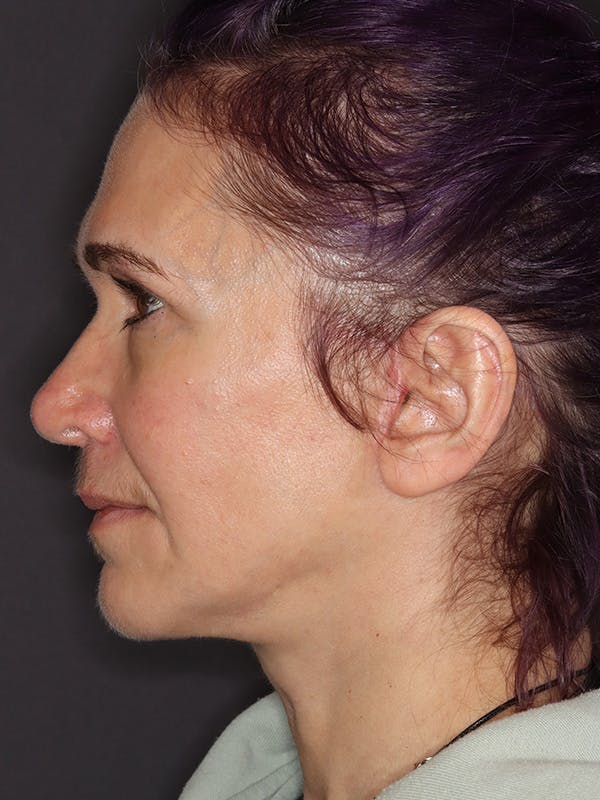 Neck Lift Gallery Before & After Gallery - Patient 543940 - Image 10