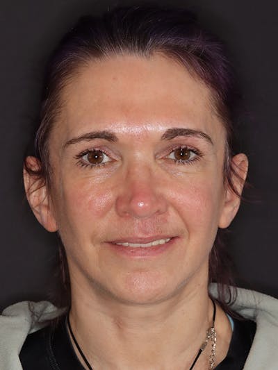 Neck Lift Gallery Before & After Gallery - Patient 543940 - Image 6