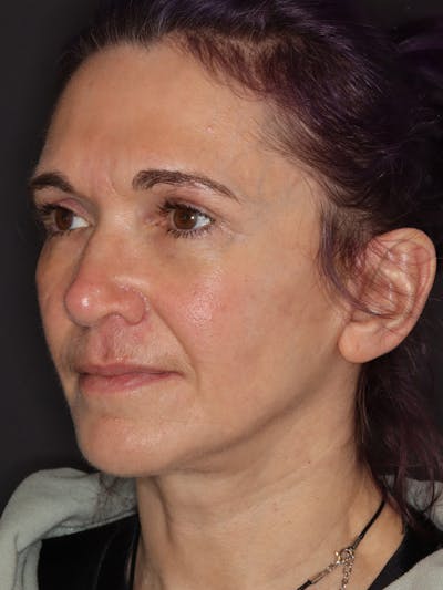 Neck Lift Gallery Before & After Gallery - Patient 543940 - Image 8